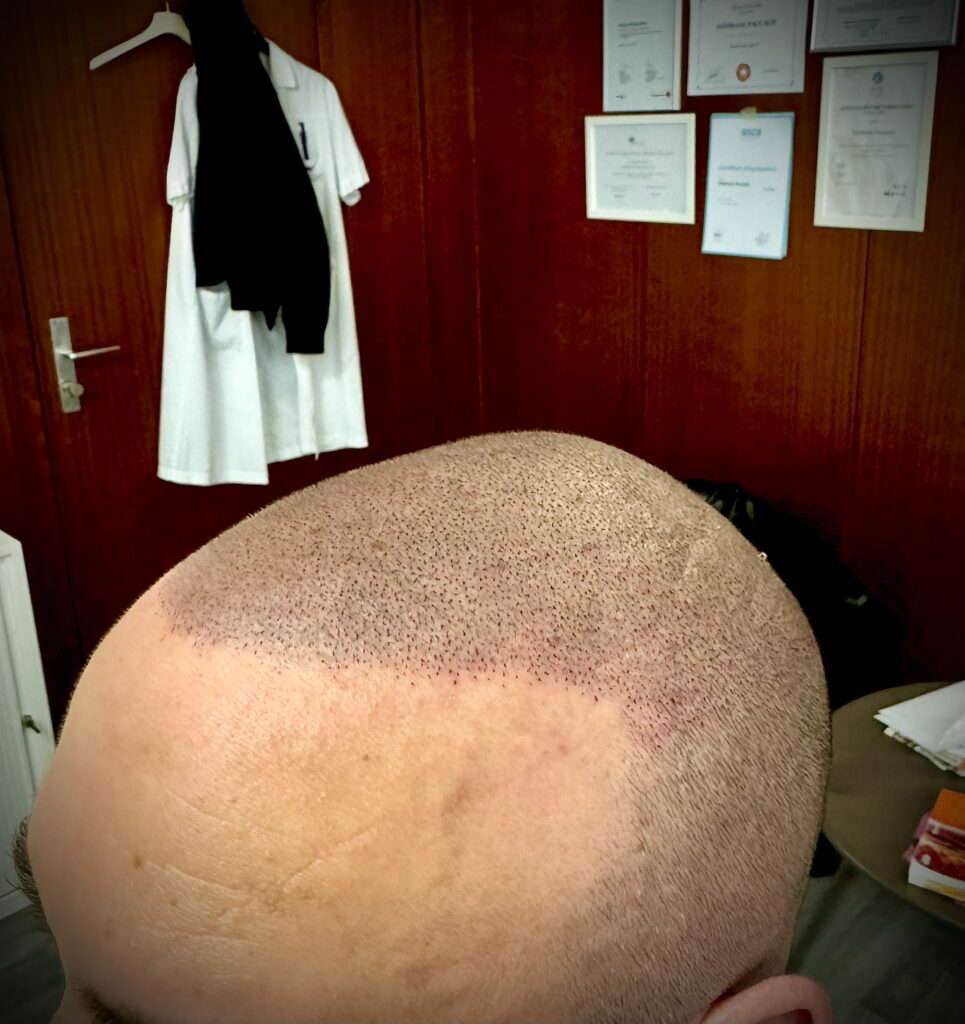tatouage capillaire par hairdensity.ch tricopigmentation
